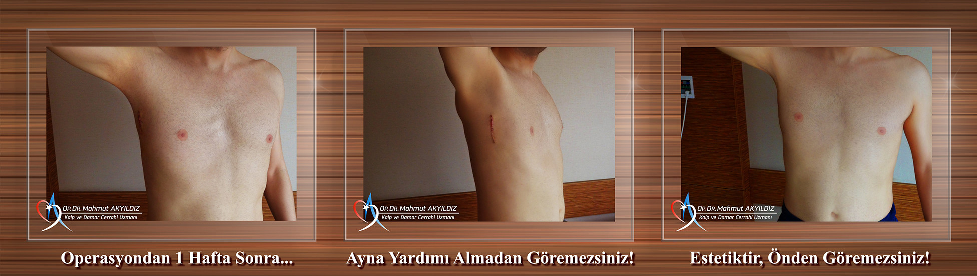 Underarm Heart Surgeries Underarm Heart Surgeries