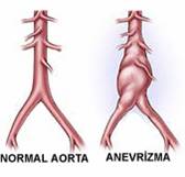 Aortic Surgery