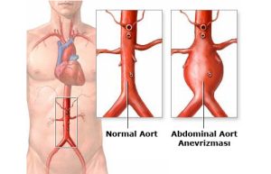 Aortic Surgery