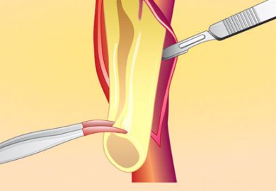 Carotid Surgery