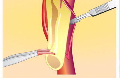 Carotid Surgery Carotid Surgery
