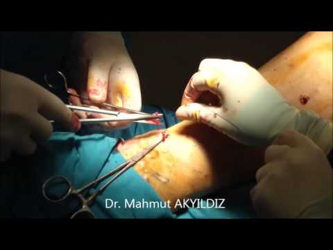 Varis Ameliyatı – Dr. Mahmut Akyıldız